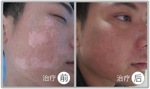 阜陽皮膚病醫(yī)院